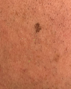 Case Review PicoAlex Before