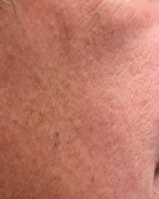 Case Review PicoAlex After