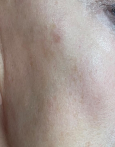 Case Review PicoAlex After