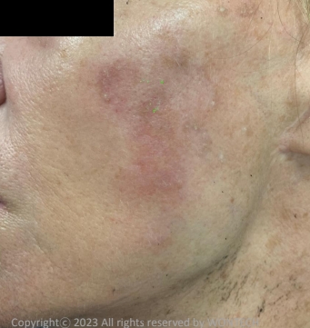 Case Review PicoAlex Before