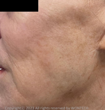 Case Review PicoAlex After