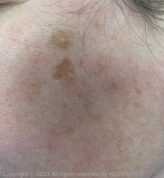 Case Review PicoAlex Before