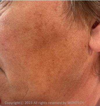 Case Review PicoAlex After