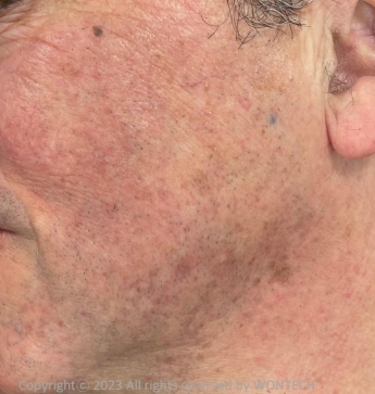 Case Review PicoAlex After