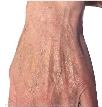 Case Review PicoAlex After