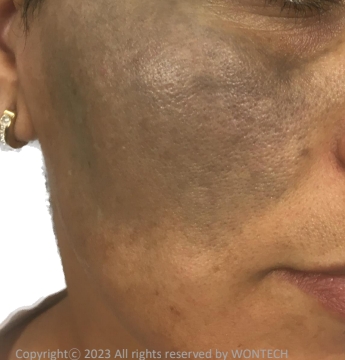 Case Review PicoAlex Before