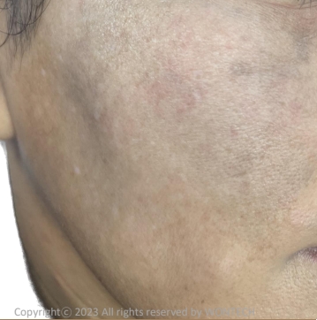 Case Review PicoAlex After