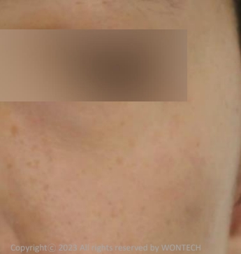 Case Review PicoAlex After