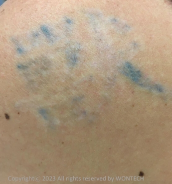 Case Review PicoAlex Before