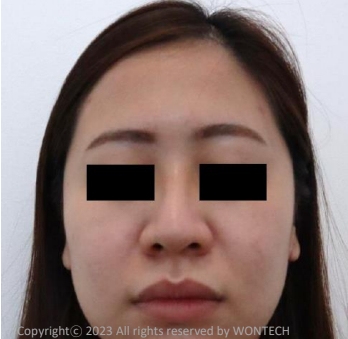 Case Review PicoAlex After