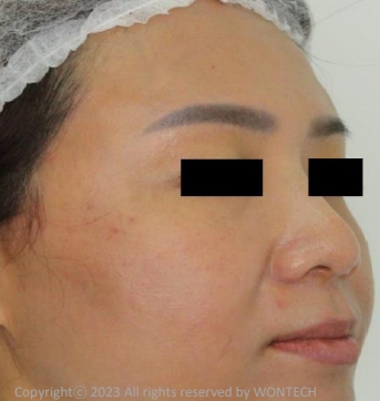 Case Review PicoAlex After