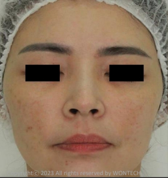 Case Review PicoAlex Before