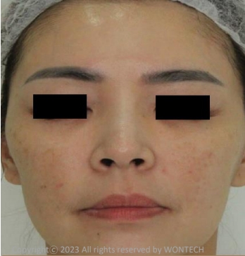 Case Review PicoAlex After