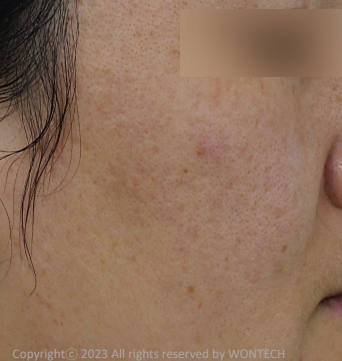 Case Review PicoAlex Before