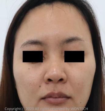 Case Review PicoAlex Before