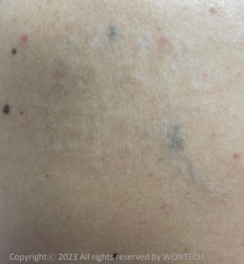 Case Review PicoAlex After