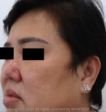 Case Review PicoAlex After