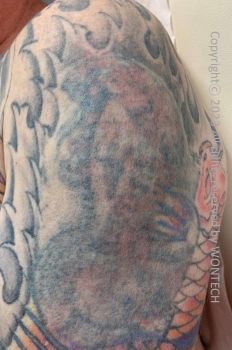 Case Review PicoAlex Before