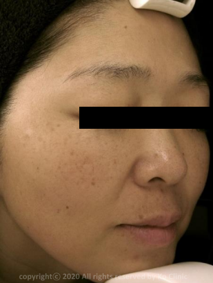 Case Review PicoAlex