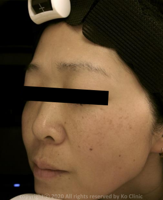 Case Review PicoAlex