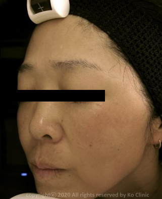 Case Review PicoAlex