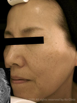 Case Review PicoAlex