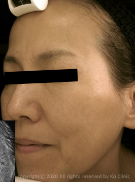 Case Review PicoAlex