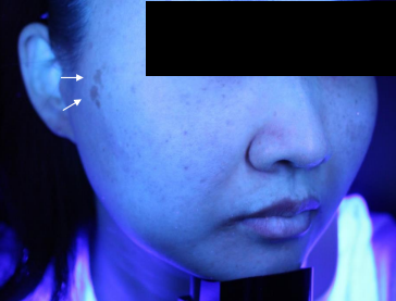 Case Review PicoAlex