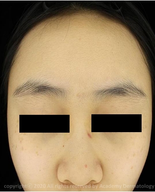 Case Review PicoAlex