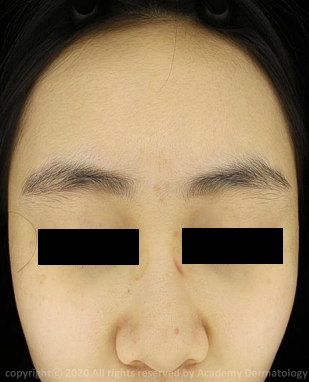 Case Review PicoAlex After